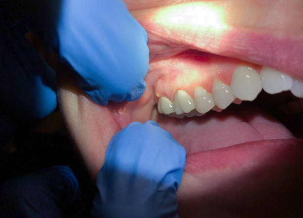 Best Emergency Dentist for Knocked-Out Tooth in Coon Rapids, IA